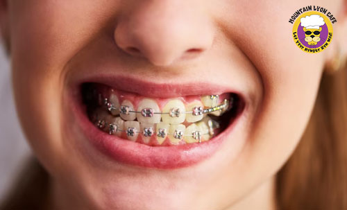 Can You Drink Coffee with Braces